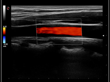 Clinical Image - MyLab<sup>™</sup>Omega - Common Carotid Artery CFM