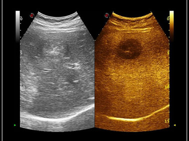 Clinical Image - MyLab<sup>™</sup>Omega - Liver Metastasis using CnTI<sup>™</sup>