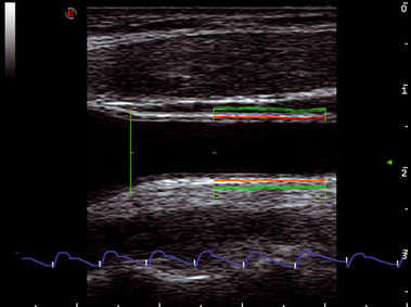 Клиническое изображение – MyLab<sup>™</sup>Seven – сонная артерия (технологии RF-QIMTи RF-QAS)