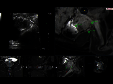 Clinical Image - MyLab<sup>™</sup>Eight eXP - Sample Tracking on transperineal prostate biopsy