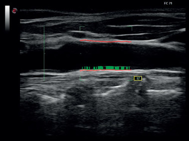 Clinical Image - MyLab<sup>™</sup>Six - Carotid Artery (QIMT Imaging)