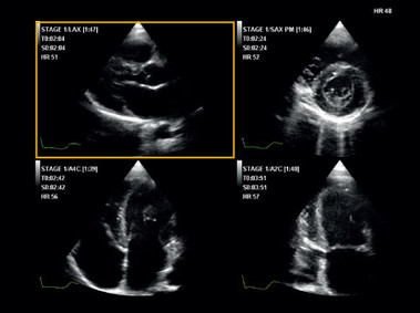 Clinical Image - MyLab<sup>™</sup>Six - Stress Echo Imaging