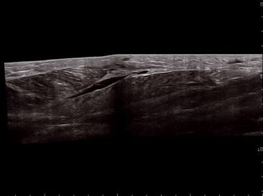 Клиническое изображение – MyLab<sup>™</sup>Twice – мышца (технология VPan)