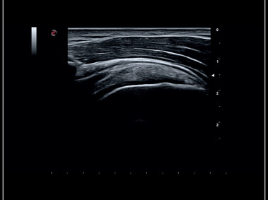 MyLab<sup>™</sup>Sigma - Clinical Image: MSK imaging of the shoulder