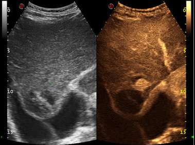Clinical Image - MyLab<sup>™</sup>Alpha - Contrast Enhanced Ultrasound Imaging