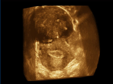 Clinical Image - MyLab<sup>™</sup>Twice - 3D Imaging - Gynaecology