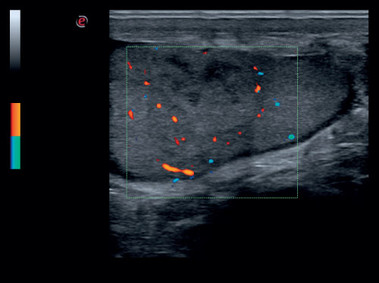 Clinical Image - MyLab<sup>™</sup>Six - Testicle (B+CFM Imaging)