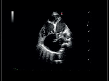MyLab<sup>™</sup>Sigma - Clinical Image: High definition B-mode cardiac imaging
