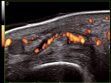 Imagen clínica - MyLab<sup>™</sup>Seven - Musculoesquelético (HF PW Doppler)