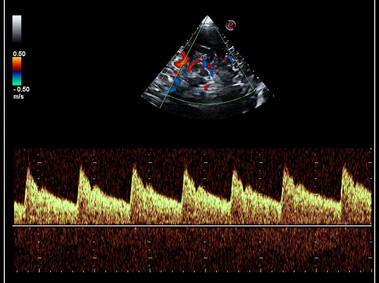 Clinical Image - MyLab<sup>™</sup>Omega - Transcranial Doppler