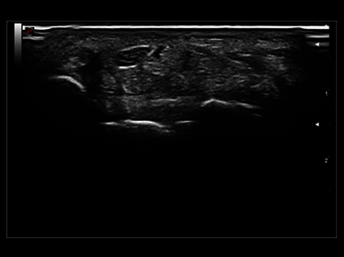 MyLab<sup>™</sup>Sigma Elite - Clinical Image - B-Mode high resolution on median nerve (not available in all countries)