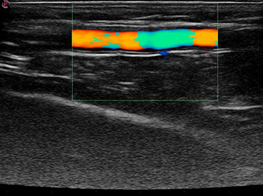 Clinical Image - MyLab<sup>™</sup>Seven - Distal part of the Radial Artery