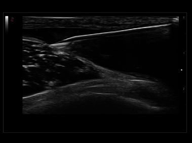 MyLab<sup>™</sup>Sigma Elite - Clinical Image - Needle Enhancement for precise interventional procedures (not available in all countries)