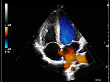 Clinical Image - MyLab<sup>™</sup>9 Platform - Ultra-sensitivity Colour Doppler for precise visualization pulmonary veins