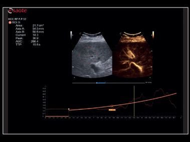 Clinical Image - MyLab<sup>™</sup>X8 Platform - Liver - Contrast session with CnTI<sup>™</sup> and Q-Pack