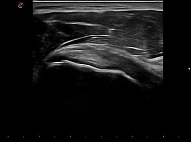Clinical Image - MyLab<sup>™</sup>Alpha - Subscapularis