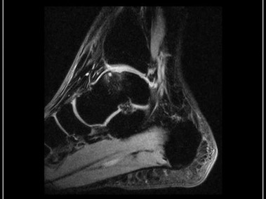 O-scan - Ankle - XBone Sagittal