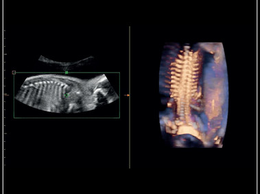 MyLab<sup>™</sup>Sigma - Clinical Image: Semi transparent rendering of fetal spine