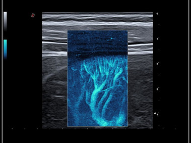 Clinical Image - MyLab<sup>™</sup>9 Platform - Hemodynamics analysis using microV on kidney