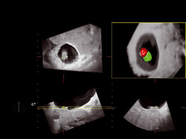 Клиническое изображение – MyLab<sup>™</sup>Twice – акушерство/гинекология (технология 4D)