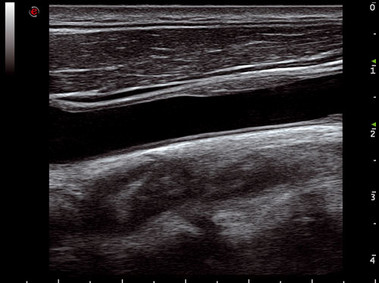 Clinical Image - MyLab<sup>™</sup>Seven - Carotid Artery