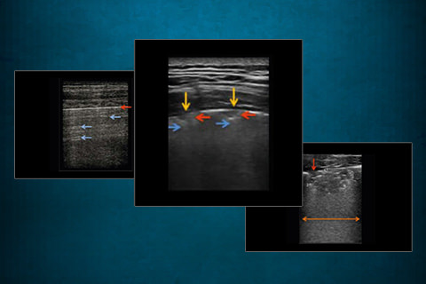 Lung Ultrasound in COVID Patients