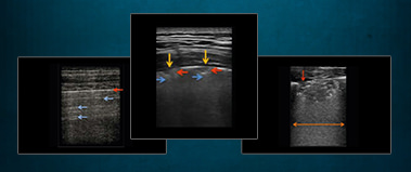 Lung Ultrasound in COVID Patients